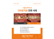 크라운치료 전후 사례