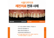앞니충치 레진치료사례