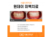 미백치료 전후사례