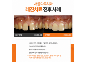 앞니벌어짐 레진치료사례