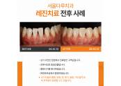 앞니 블랙트라이앵글 치료사례