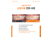 교정치료 치료사례