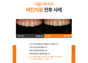 레진치료 전후사례