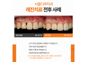 앞니블랙트라이앵글 치료사례
