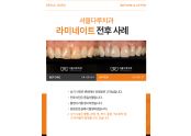 라미네이트 치료사례
